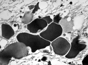 F,53y. | ochronosis … black aortal valve F,53y. | ochronosis … black aortal valve